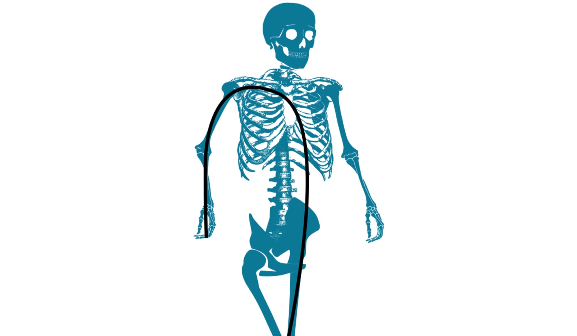 Sindrome della Catena Cinetica Superiore