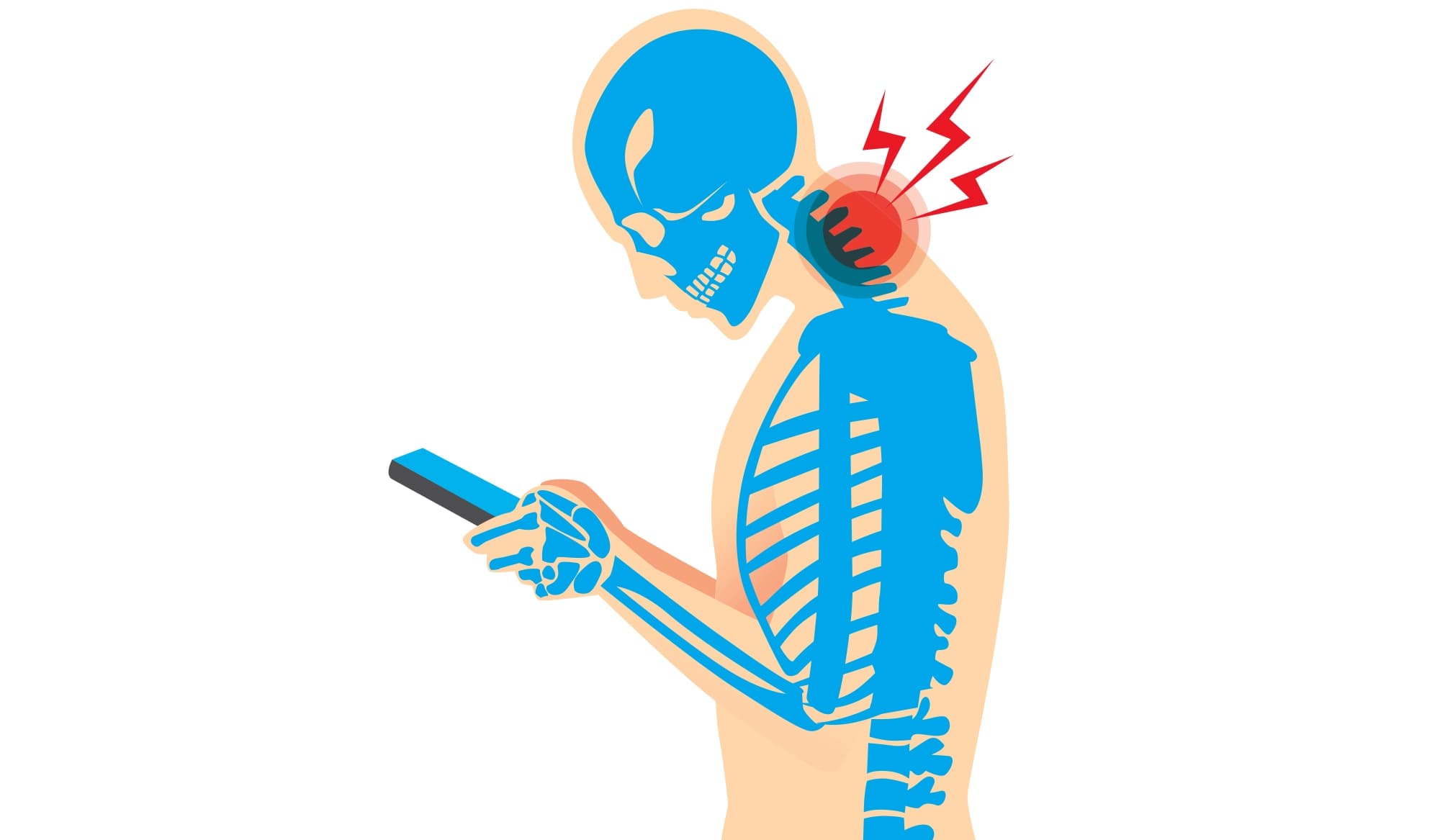 Cosa significa Cattiva Postura