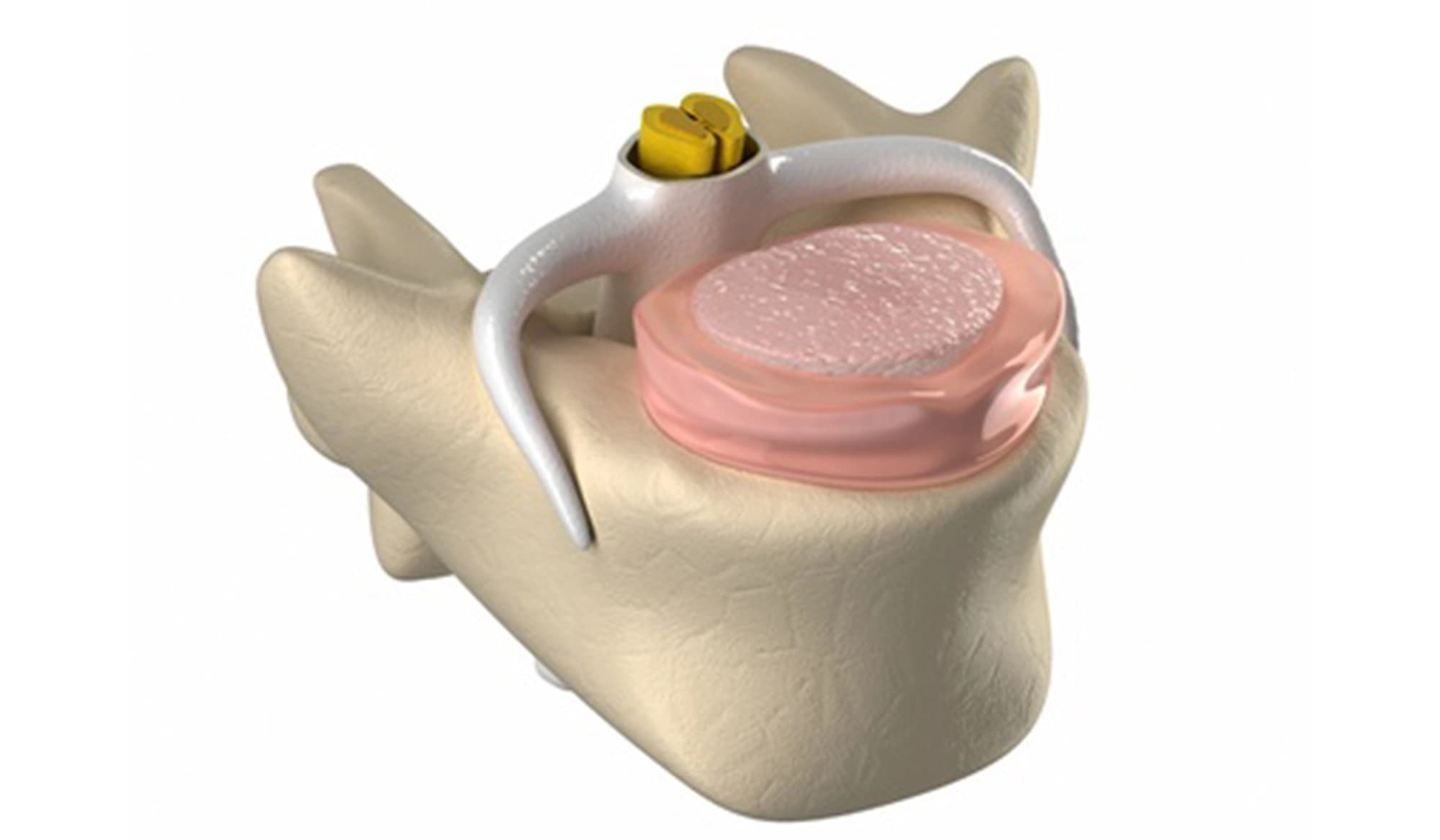 Stenosi Spinale Lombare